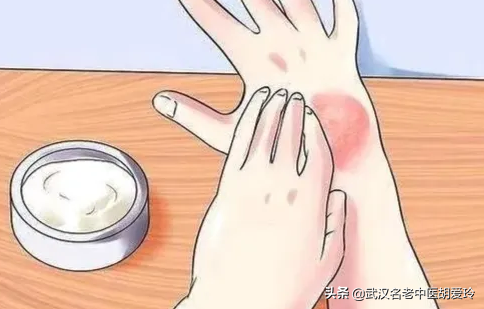 手脱皮是什么原因导致的不痒不痛该擦什么药（手脱皮什么原因造成）