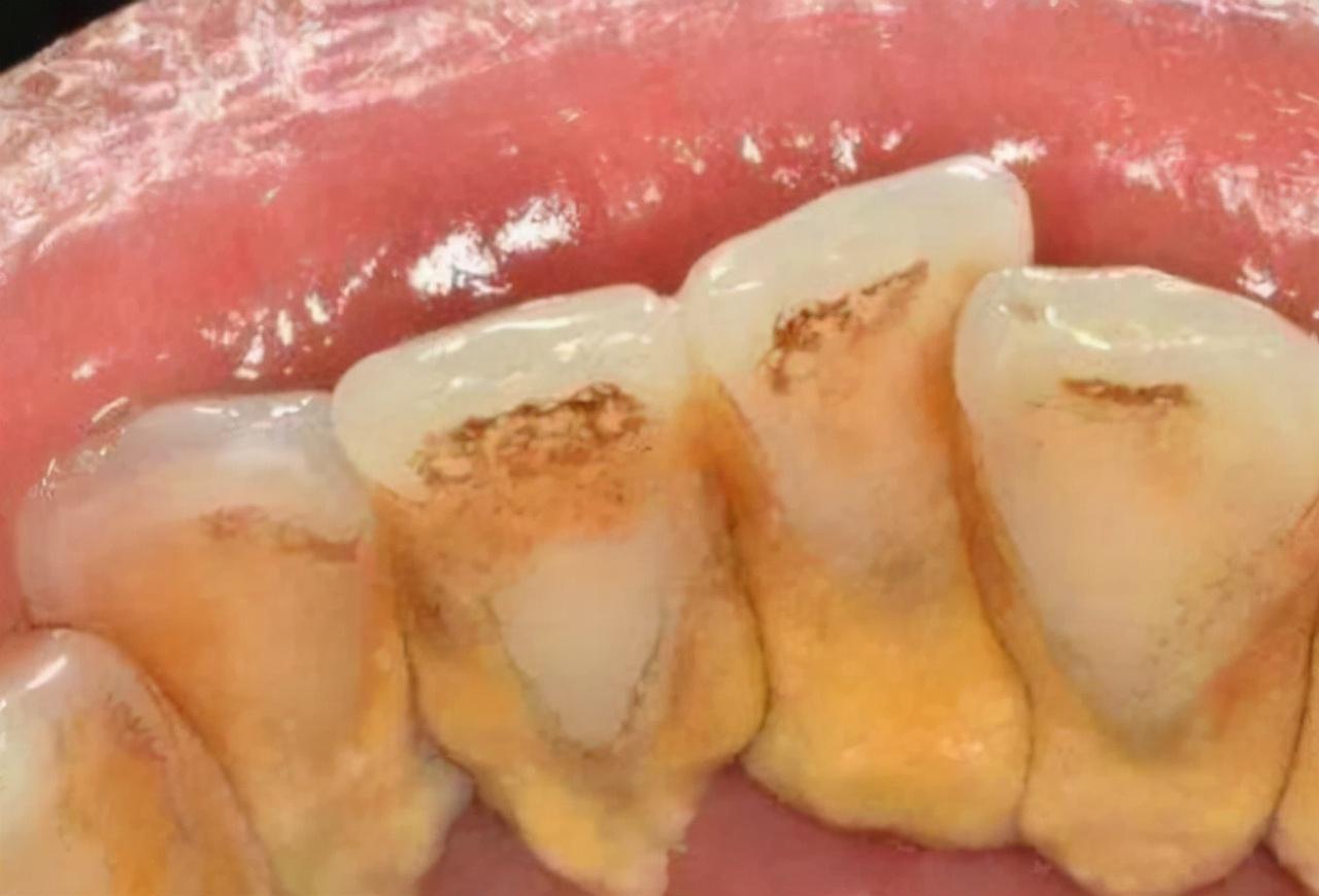“牙结石”可以自己抠掉吗？教你一招，牙缝的脏东西或能轻松掉（抠出来的牙结石）