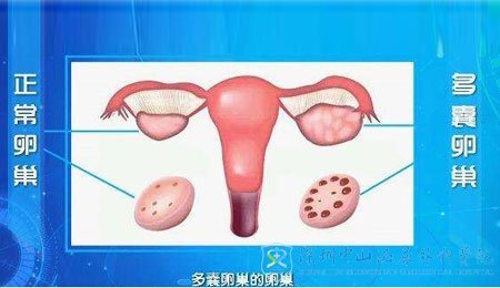 多囊卵巢能怀上孩子吗？卵巢多囊能自愈吗？（卵巢多囊可以要孩子吗）