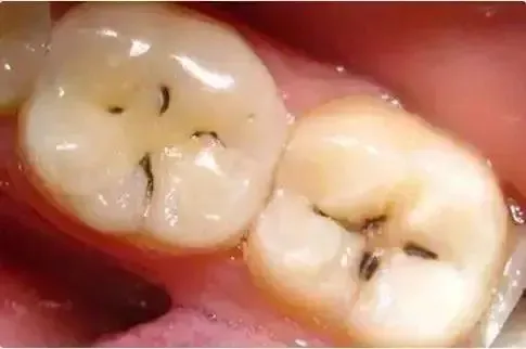 蛀牙龋齿如何让它停止腐蚀？口腔师的3个预防妙招！（蛀牙怎样防止进一步蛀牙）