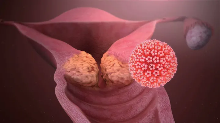 感染HPV后，身体会出现哪些症状？（HPV感染后有症状吗）