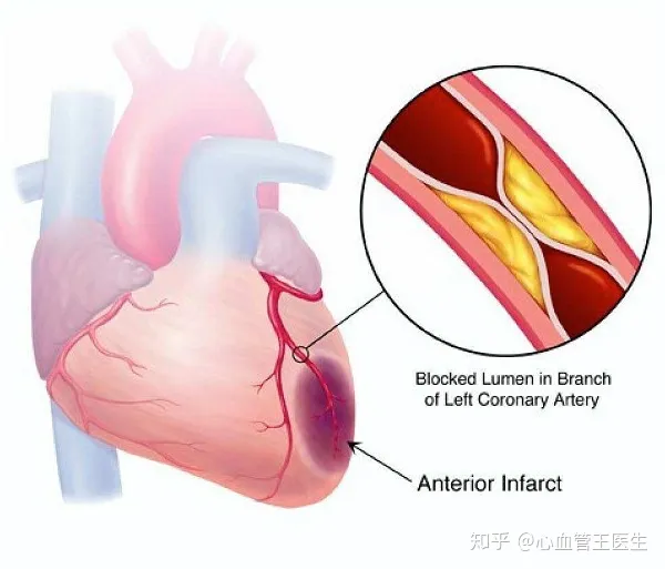 心肌缺血有哪些临床表现（心肌缺血的典型心电图表现）
