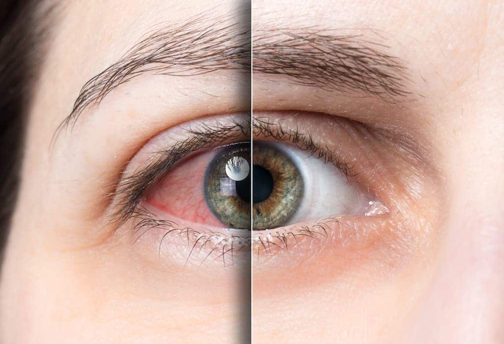眼睛有血丝怎么消除 - 眼睛发红和充血的 18 个原因以及如何解决（眼睛充血是血丝吗）