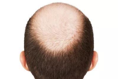 上海莱森： 头顶头发稀疏怎么预防？有哪些方式呢？（上海莱森医疗美容门诊部怎么样）