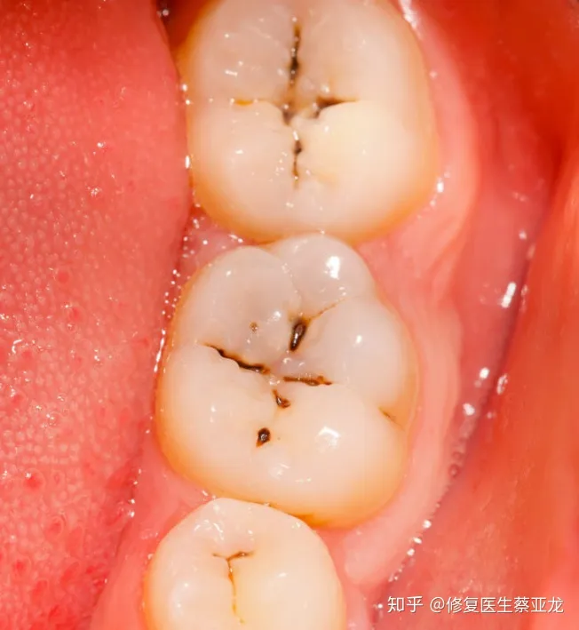 长沙修复医生讲：蛀牙如何让它停止腐蚀？（蛀牙如何让它减缓腐蚀）